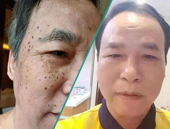 老年斑及轻度中风